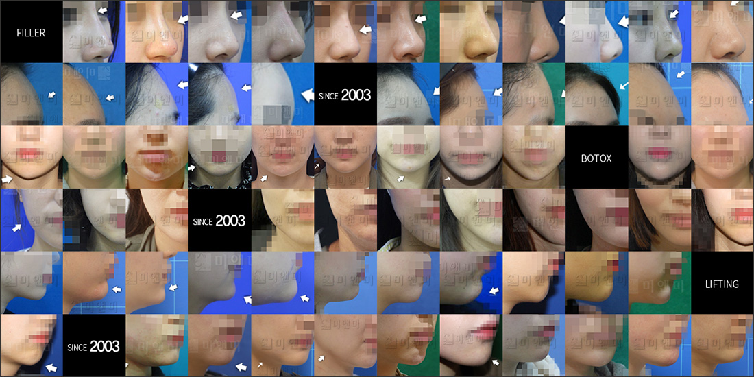 SINCE 2003 MI&MI, 시술후사진모음 서울대입구피부과 미앤미 깨끗한 변화를 만나는 365일 진료