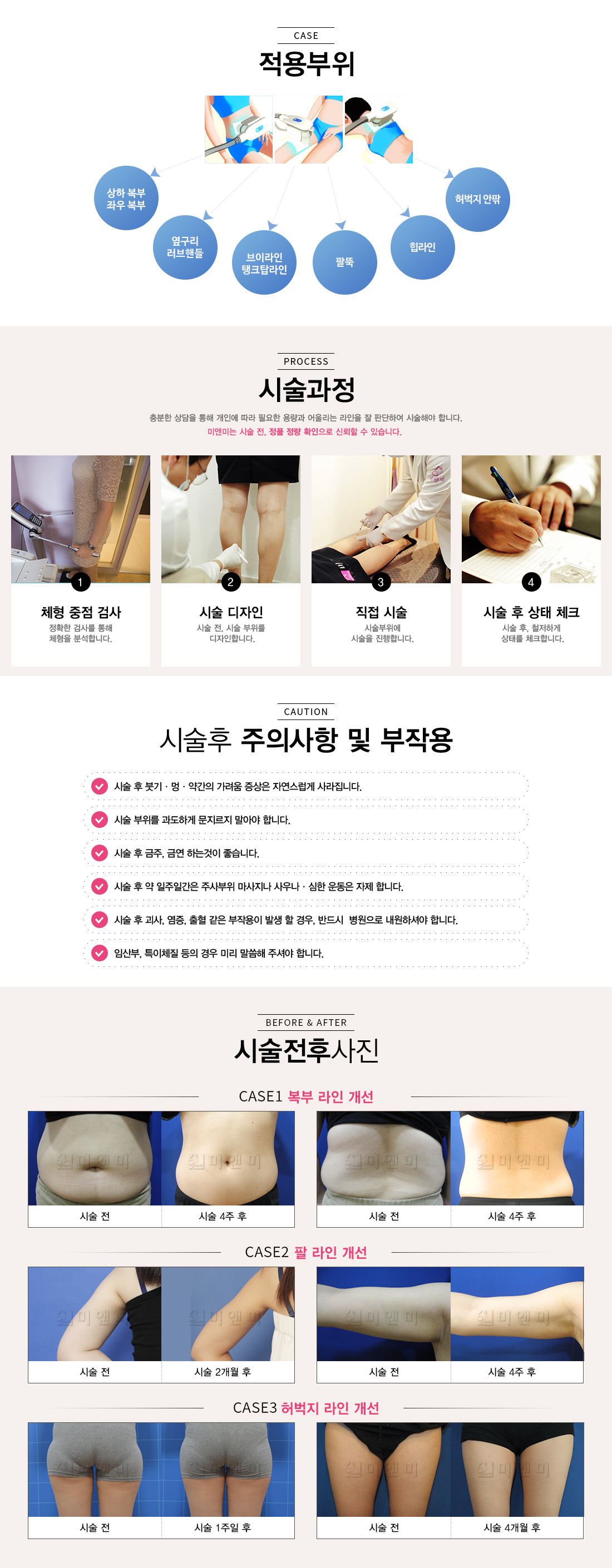 냉동지방분해술
